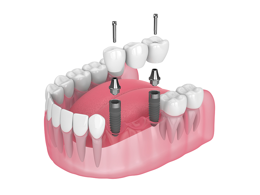 The Importance of Dental Bridges