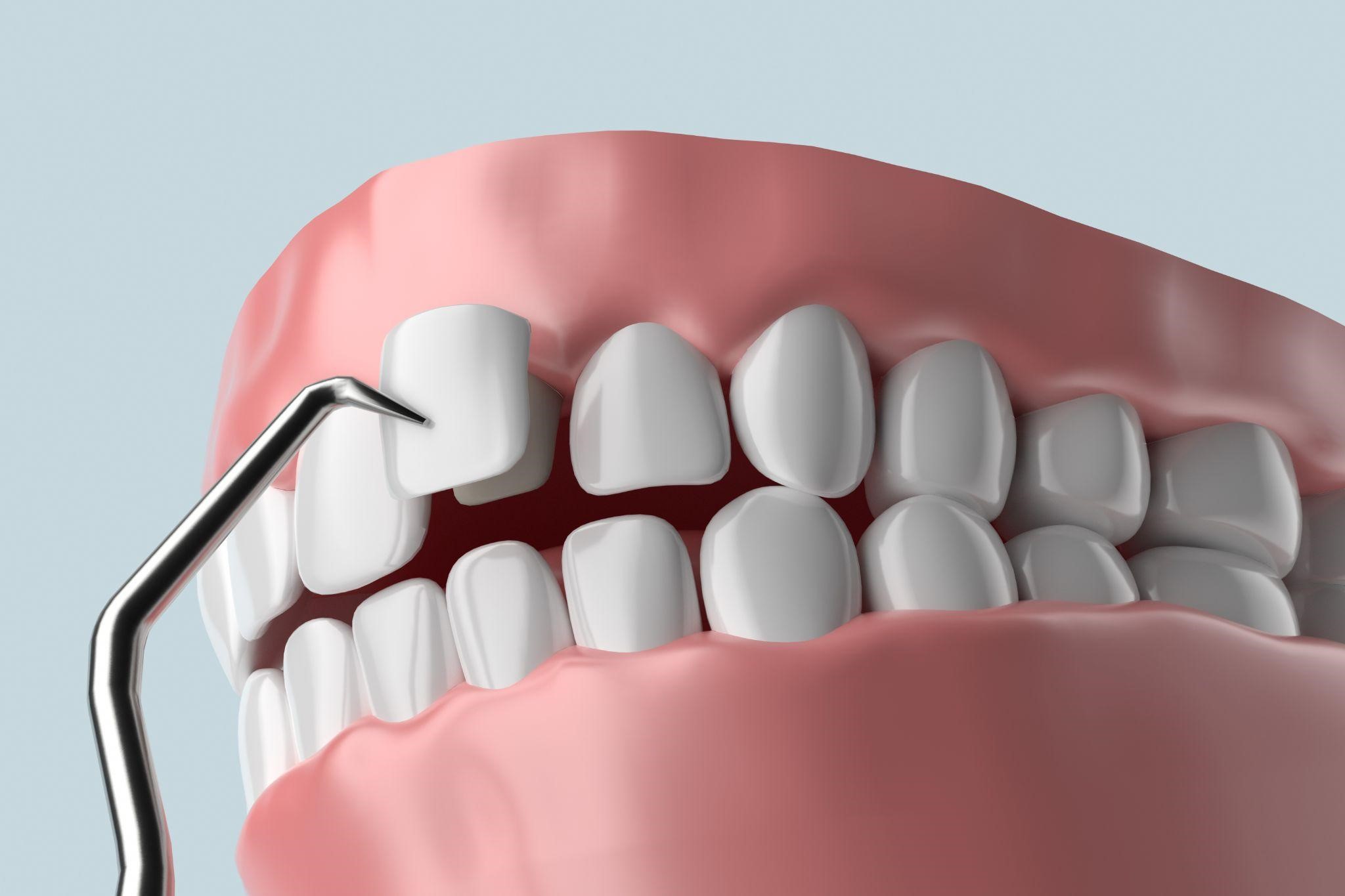 Why Choose Dental Veneers?
