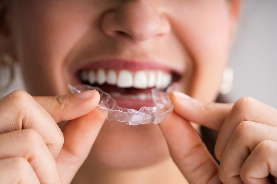 Invisalign – Your Hassle-free Alternative To A Perfect Smile