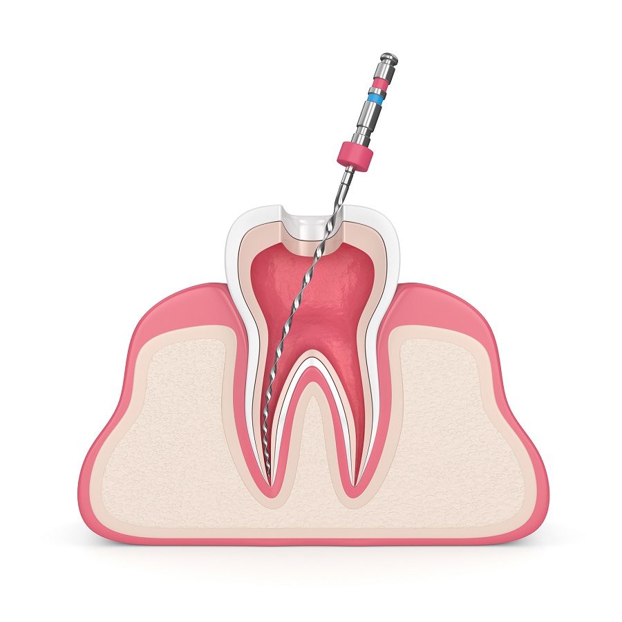 How to Recover from a Root Canal