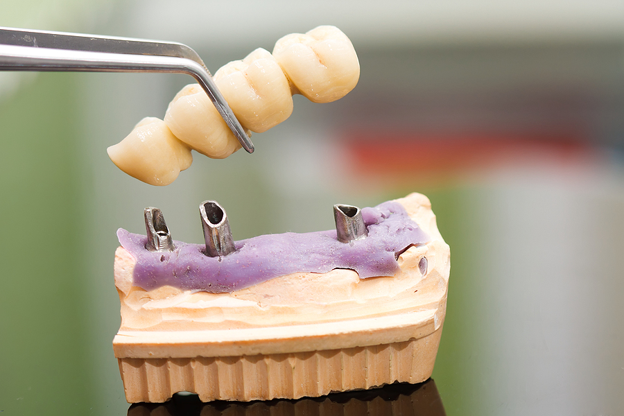 Transform Your Smile Using Dental Implants