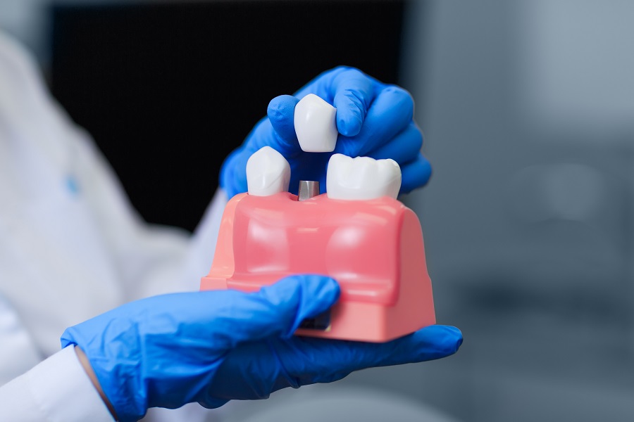How We Work as a Team to Restore your Dental Health with Implants